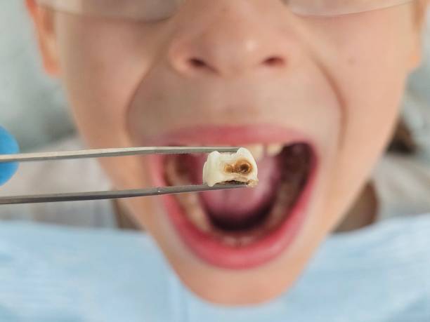 Emergency Dental Filling Replacement in VA